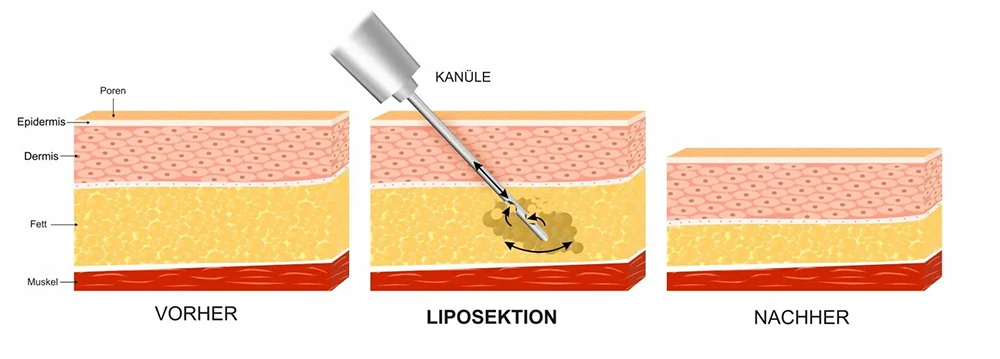 Liposuktion Operation